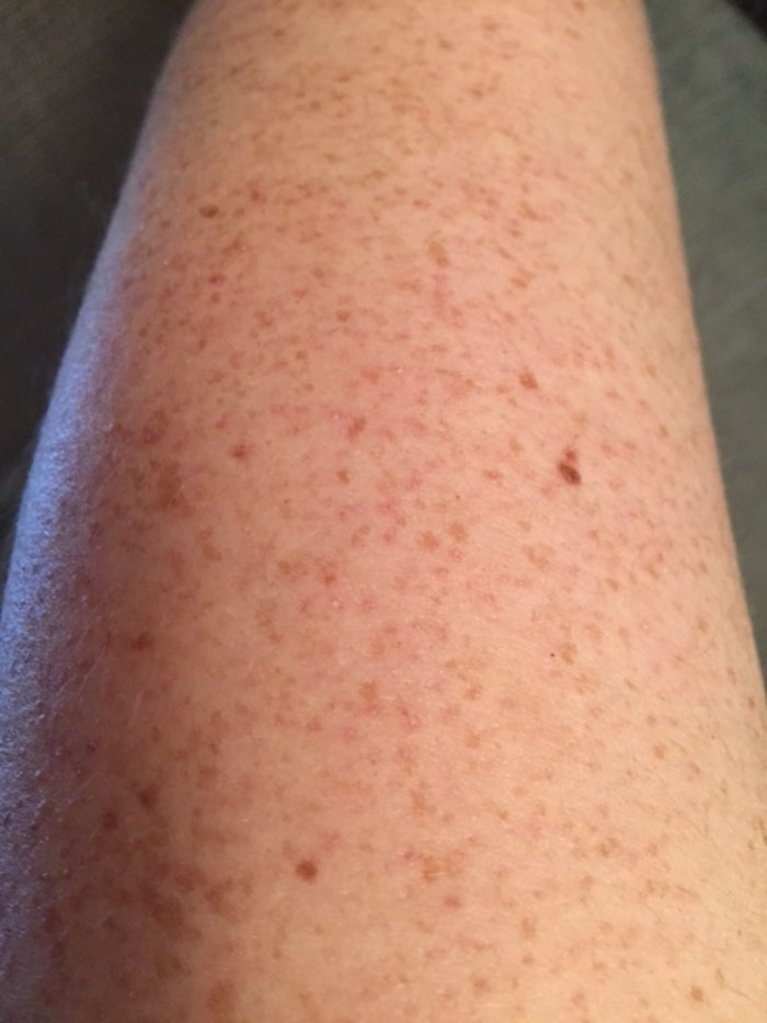 Those Bumps On Your Upper Arms Are Called Keratosis 